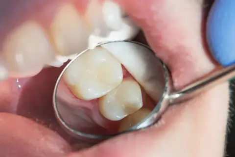 Stomatolog bada zęby, szukając próchnicy ukrytej. Widać fragment jamy ustnej, zęby i lusterko dentystyczne.