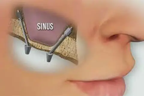 Illustrazione di un sinus lift: due impianti dentali inseriti nell'osso mascellare superiore, vicino al seno mascellare.