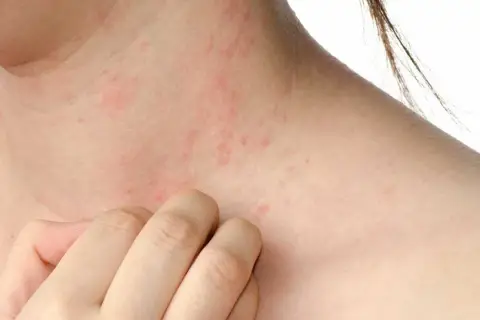 Piel irritada con enrojecimiento y pequeños bultos, indicando posible reacción a ácaros, alergia en la piel.