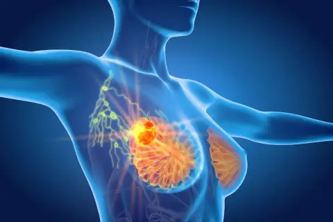 Anatomical rendering showing a tumor in the breast and enlarged lymph nodes, indicating limfadenopatia.