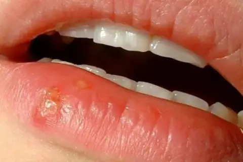 Una llaga en el labio inferior, con pequeñas ampollas y enrojecimiento.