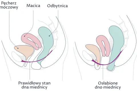 Ilustracja porównuje prawidłowy stan dna miednicy z osłabionym, pokazując, jak wypadanie macicy może wpływać na narządy.