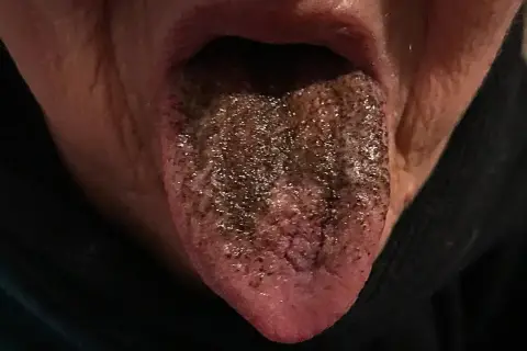 Lingua nera con papille ispessite e macchie scure, come se fosse coperta di terra.