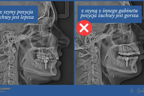 Rentgen żuchwy: po lewej bez szyny Michigan, pozycja lepsza. Po prawej z szyną, pozycja gorsza.