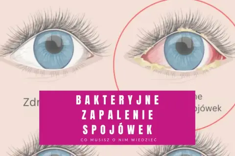 Zdrowe oko obok oka z objawami bakteryjnego zapalenia spojówek: zaczerwienienie, obrzęk i wydzielina.