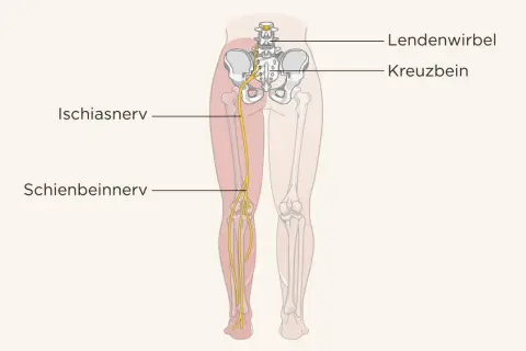 Der Ischiasnerv verläuft vom Kreuzbein durch das Bein bis zum Schienbein.