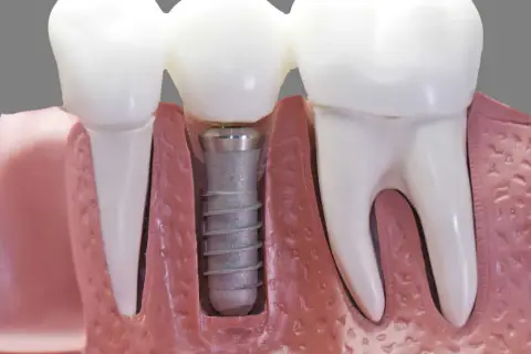 Czy po wszczepieniu implantu zęba można iść do pracy bez obaw?
