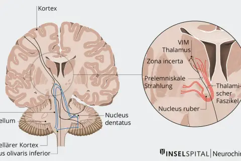 Hirnschnitt mit Darstellung von Nervenbahnen, die vom Kortex zum Thalamus und Kleinhirn verlaufen. Der primäre Fokus liegt auf dem Thalamus und seinen Verbindungen.
