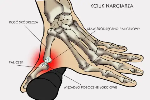 Anatomia kciuka narciarza: kość śródręcza, paliczek i staw śródręczno-paliczkowy. Czerwony obszar wskazuje ból.