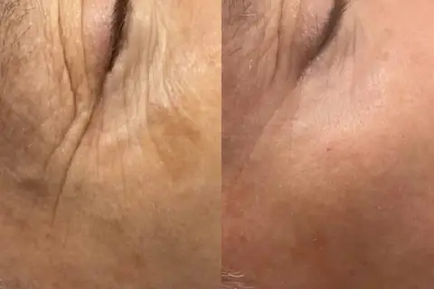 Split image showing before and after of skin treated with fractional CO2 laser, with reduced wrinkles.