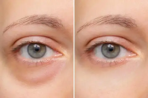 Vorher-Nachher-Vergleich: Deutliche Reduzierung von Augenringen und Schwellungen unter dem Auge.