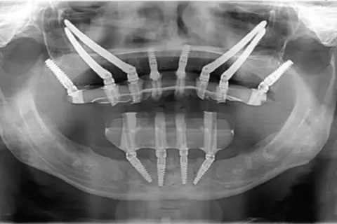 Radiografia panoramica mostra impianti dentali posizionati in arcate mascellari con ridotta quantità di osso, una soluzione per chi necessita di impianti dentali senza osso.