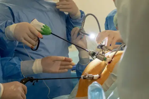 Chirurdzy w rękawiczkach i fartuchach przeprowadzają laparoskopię, używając narzędzi do precyzyjnej operacji.