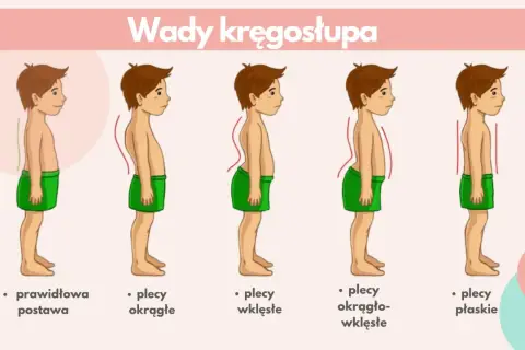 Ilustracja pokazuje wady kręgosłupa: plecy okrągłe, wklęsłe, okrągło-wklęsłe i płaskie. Lordoza to nadmierne wygięcie kręgosłupa.