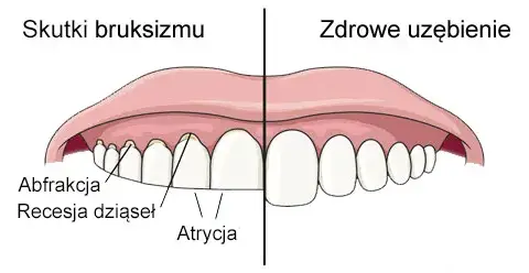 Co oznacza zgrzytanie zębami przez sen i jak temu zapobiec