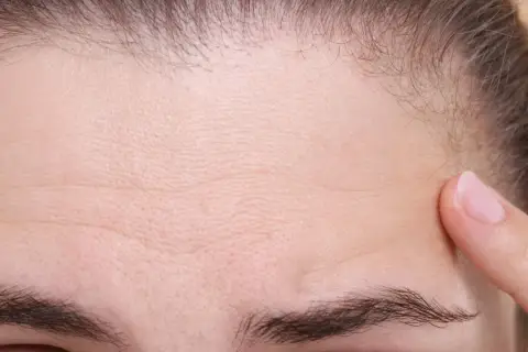 Primer plano de una frente con arrugas finas y una ceja poblada, casi una uniceja. Un dedo toca suavemente la piel.
