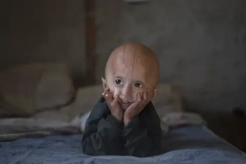 Uśmiechnięte dziecko z progerią leży na łóżku, opierając głowę na dłoniach.