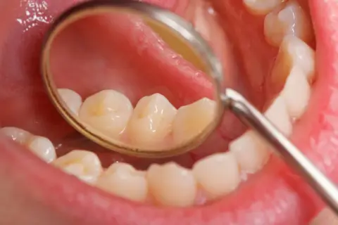Widok jamy ustnej z lusterkiem dentystycznym. Na zębach widoczne są żółtawe przebarwienia, które mogą być początkiem próchnicy lub osadu.