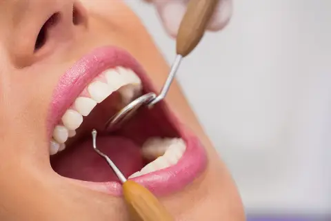 Usta kobiety z białymi zębami, badane przez dentystę. Widoczna jest niewielka kieszonka dziąsłowa.