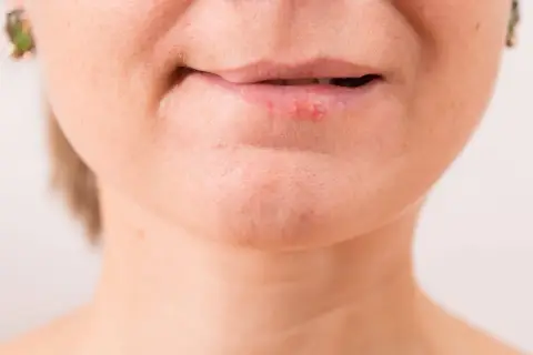 Labios con herpes, posiblemente por exposición al sol.