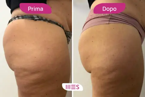 Prima e dopo: miglioramento della cellulite grazie all'ozonoterapia. Scopri il ozonoterapia cellulite costo per un corpo più liscio.