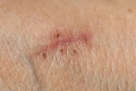 Piel con varias cicatrices, algunas con puntos de sutura visibles.