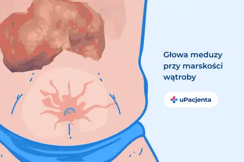 Ilustracja przedstawia objawy marskości wątroby, takie jak "głowa meduzy" na brzuchu. Dzięki leczeniu, wyleczyłem marskość wątroby.