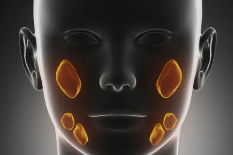 Anatomical rendering of a human head showing salivary glands highlighted in yellow. This visualization helps understand the location of potential kamica ślinianek.