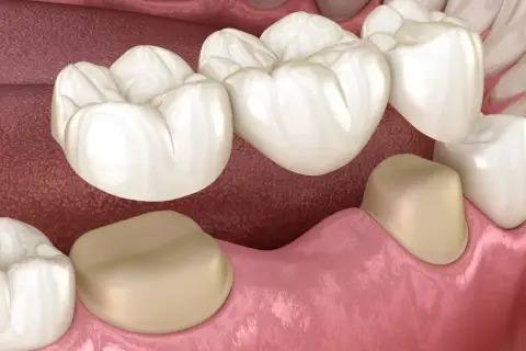 Model protetycznego mostu dentystycznego na zębach.