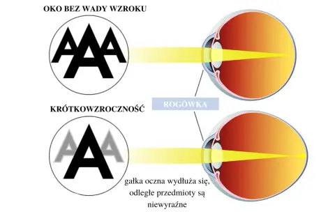 Oko z krótkowzrocznością: światło skupia się przed siatkówką, przez co odległe przedmioty są niewyraźne. Oko bez wady widzi ostro.