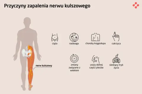 Ilustracja przedstawia przyczyny zapalenia nerwu kulszowego: ciążę, nadwagę, choroby kręgosłupa, cukrzycę, zmiany związane z wiekiem, urazy pleców i siedzący tryb życia.