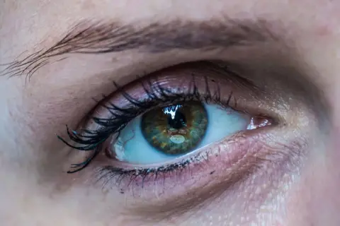 Nahaufnahme eines Auges mit einem leicht geschwollenen Augenlid. Die Iris ist grünlich-braun mit feinen Sprenkeln.