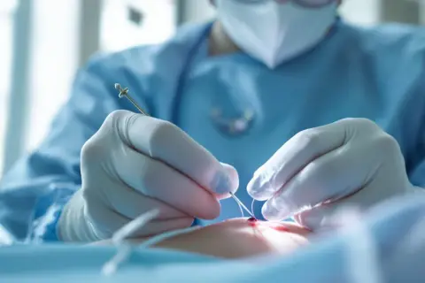 Mains gantées d'un chirurgien suturant une plaie avec précision. Le nombre de point de suture par cm est crucial pour une guérison optimale.