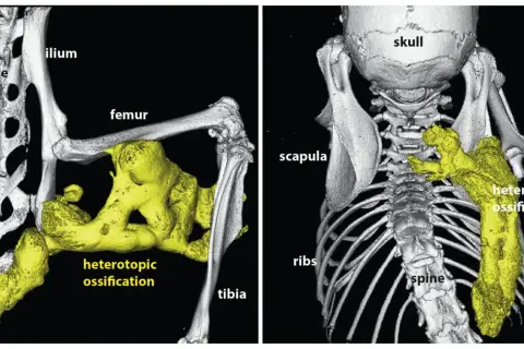 Imagerie 3D montrant une fibrodysplasie ossifiante progressive avec ossification hétérotopique jaune autour du fémur, du tibia et de la colonne vertébrale.