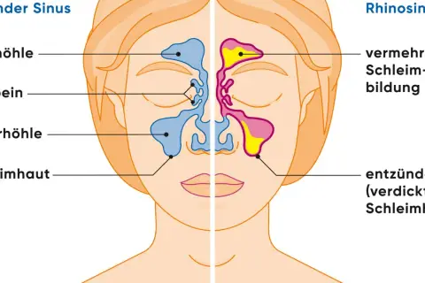 Vergleich gesunder Sinus und Rhinosinusitis: Entzündete Schleimhaut und vermehrte Schleimbildung sind typische nasennebenhöhlenentzündung symptome.