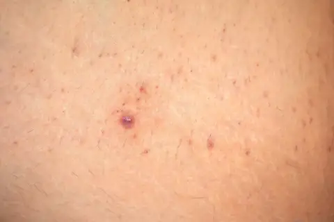 Primer plano de piel con pequeñas imperfecciones y vello fino, con una zona que recuerda a la piel de fresa.