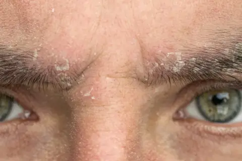 Primer plano de la frente y ojos de una persona con escamas blancas y piel irritada, indicativo de seborrea.