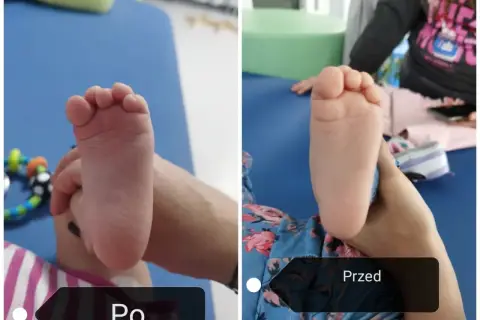 Dwa zdjęcia stopy dziecka: po lewej stopa sierpowata, po prawej ta sama stopa po terapii.