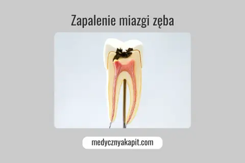 Przekrój zęba ukazujący próchnicę sięgającą do miazgi zęba, która jest zaczerwieniona i zaogniona.