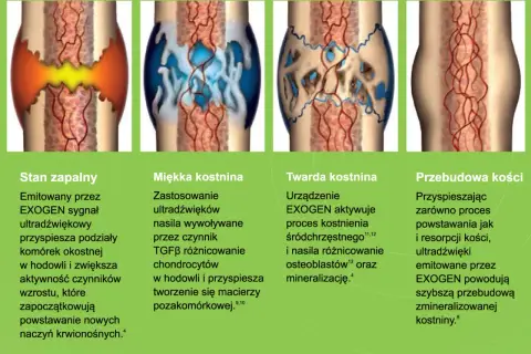 Ilustracje pokazują etapy gojenia kości: stan zapalny, miękką i twardą kostninę, a na końcu przebudowę kości. Proces ten, dzięki EXOGEN, przyspiesza tworzenie nowej tkanki kostnej, redukując problem **łamliwości kości**.