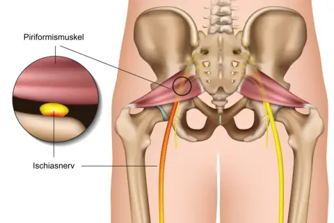 Piriformis-Muskel drückt auf Ischiasnerv, Ursache für Ischias Schmerz. Detailansicht zeigt Nerveneinklemmung.