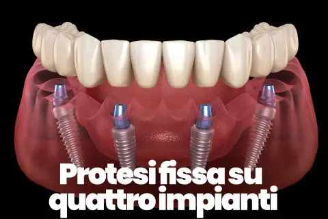 Protesi fissa su quattro impianti dentali, mostrando la struttura ossea e i pilastri che sostengono i denti.