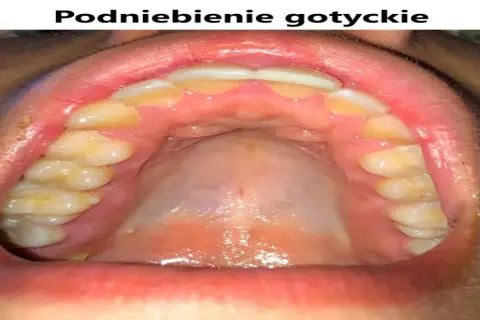 Widok jamy ustnej z zębami i podniebieniem. Podniebienie gotyckie, zdrowe, z widocznymi zębami.