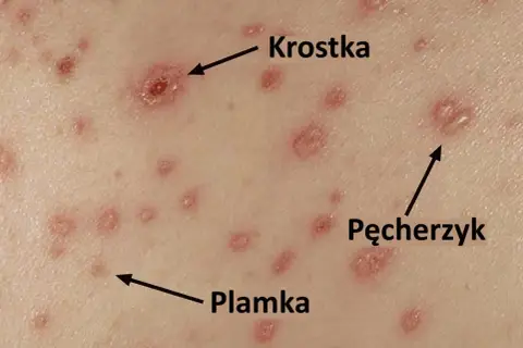 Zmiany skórne charakterystyczne dla ospy wietrznej: plamki, krostki i pęcherzyki.