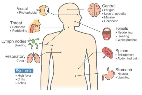Síntoma de la mononucleosis: identifica los signos y evita complicaciones