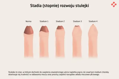 Ilustracja przedstawia stadia rozwoju stulejki, od normy do stadium 4, pokazując stopniowe zwężenie napletka.
