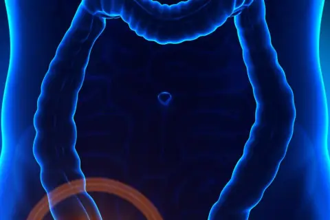 Anatomical illustration showing the intestines with a highlighted area indicating potential zapalenie wyrostka robaczkowego.