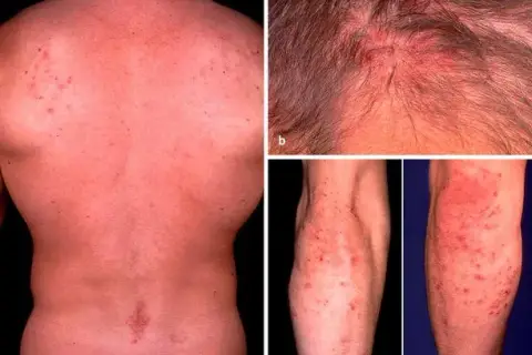 Morbus Duhring Diagnostik: Wichtige Tests und Verfahren zur sicheren Diagnose