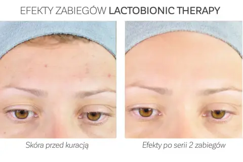 Przed i po zabiegu z kwasem laktobionowym: skóra z niedoskonałościami staje się gładka i czysta.