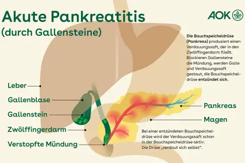Illustration zeigt Gallensteine, die die Mündung blockieren und eine akute Pankreatitis auslösen. Symptome können durch diese Blockade entstehen.